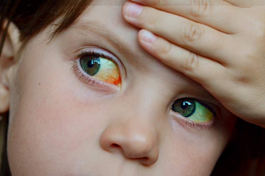 hepatitis_infantil
