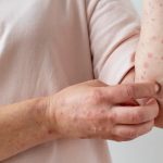 SESVER: En Veracruz no hay registro de contagios por sarampión